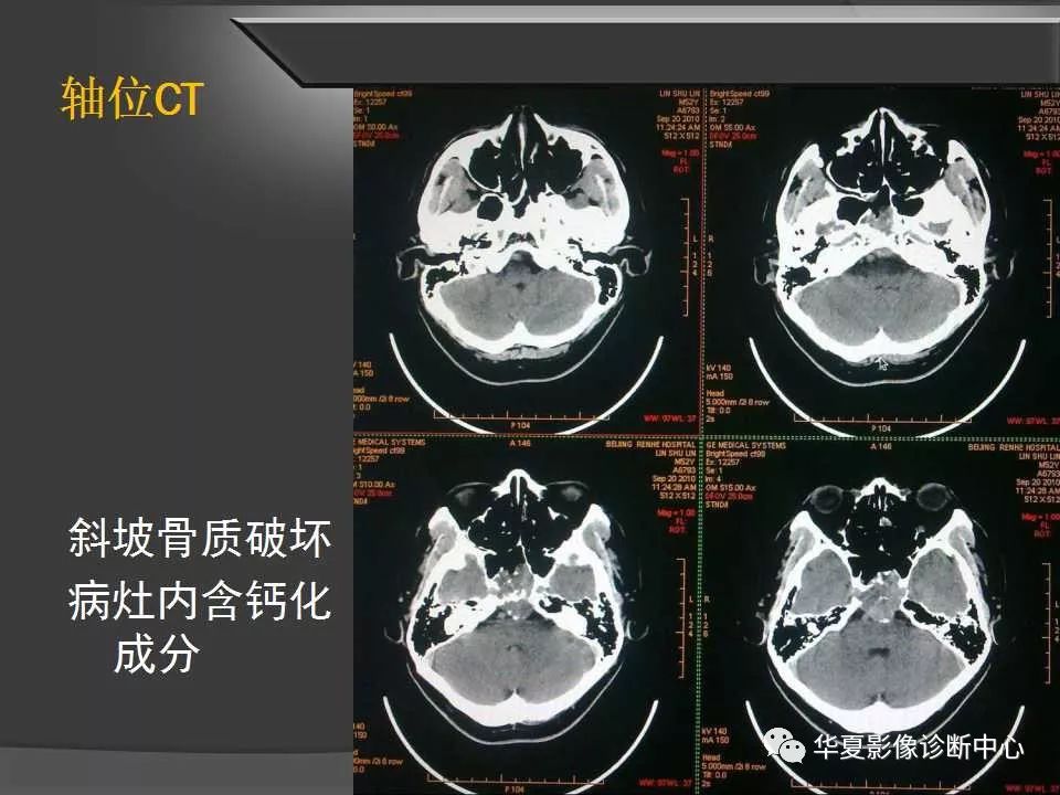 颅内斜坡图片