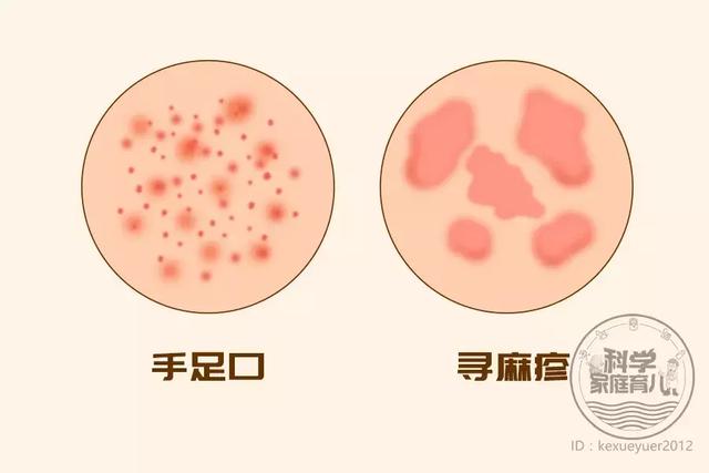 水痘和疹子的区别图片