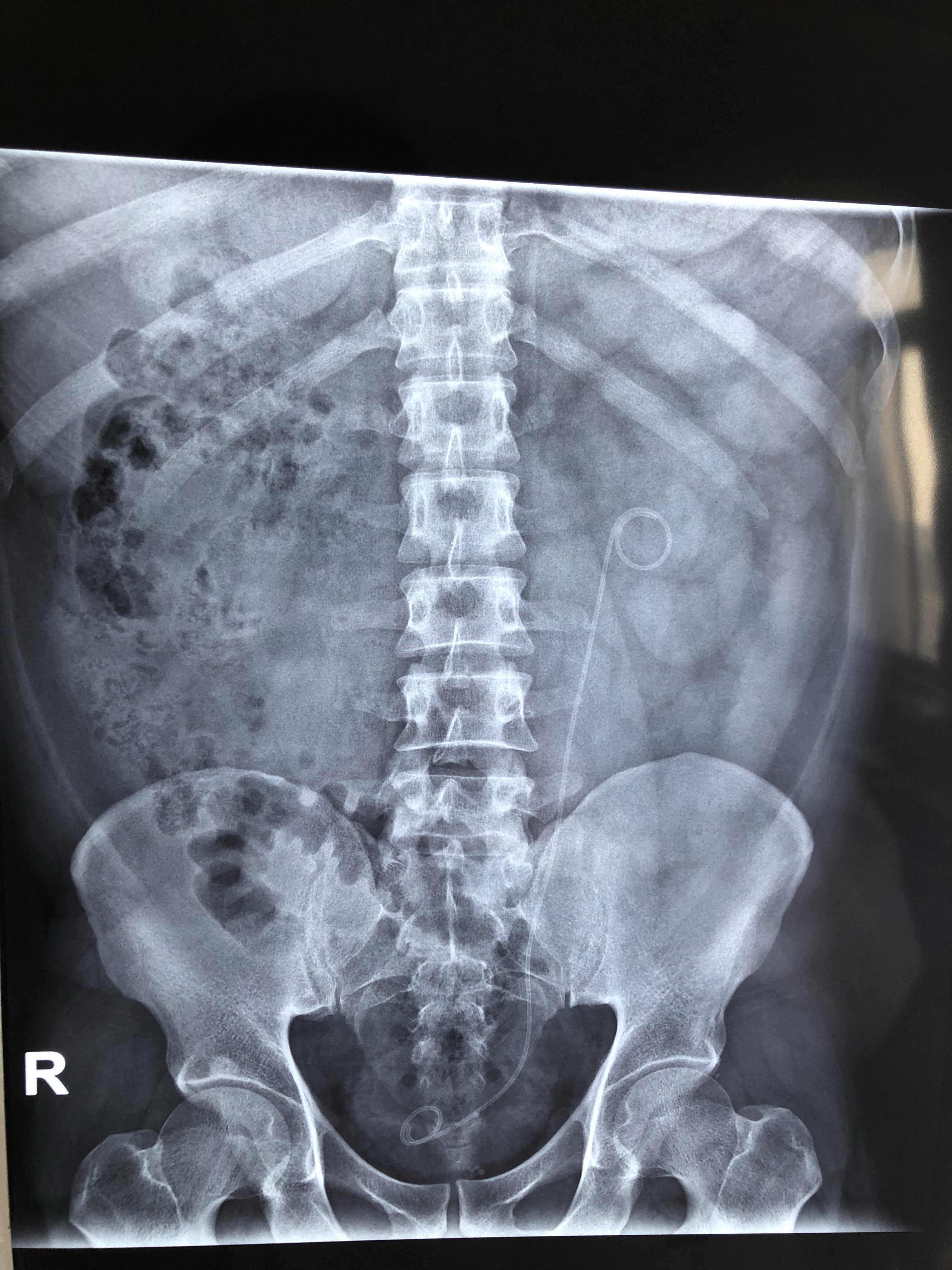 输尿管结石x光片图片图片