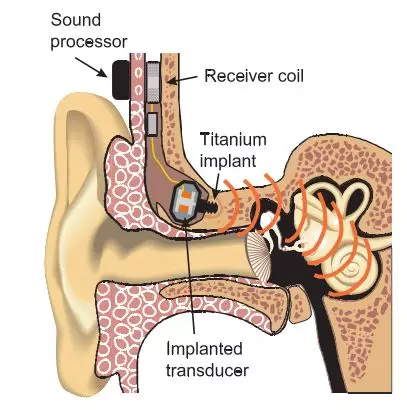 听骨链畸形图片