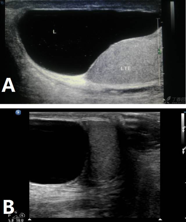 睾丸外鞘膜彩超图片图片