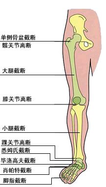 女主髋离断截肢文图片