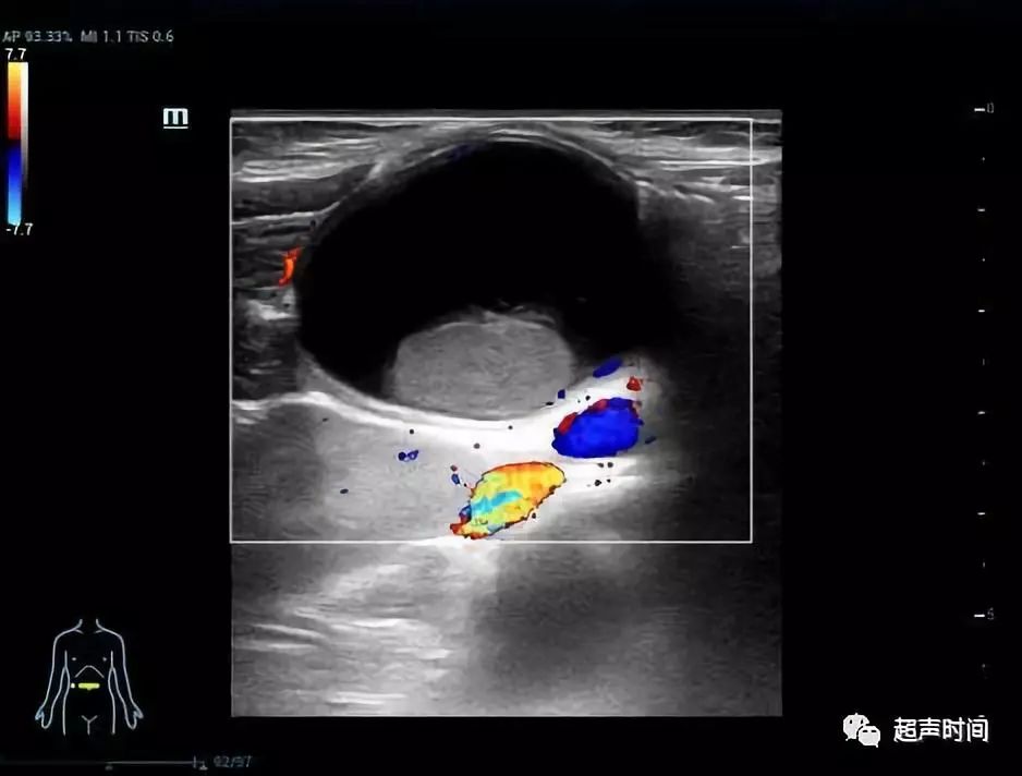肠系膜囊肿超声图片图片
