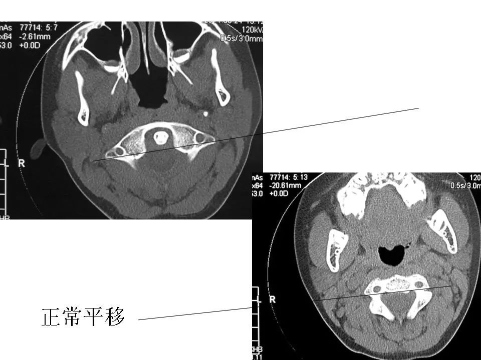 寰枢关节CT解剖图图片