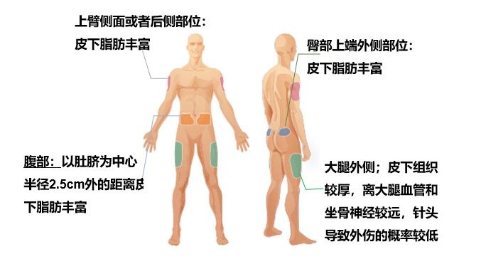 肝素钙打大腿哪个位置图片