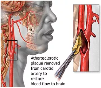 頸動脈狹窄四大危險,不可不知!