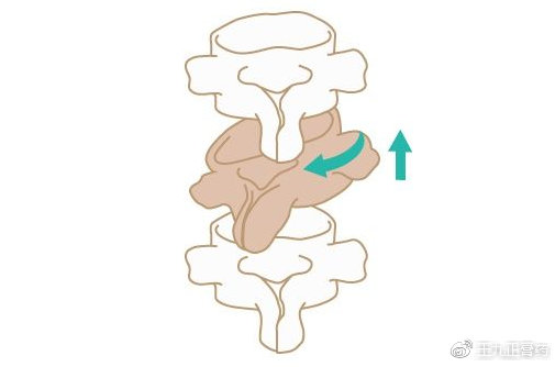 右侧旋滑脱椎体不稳的