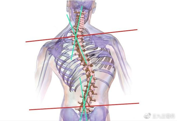 不是突出不是增生頸椎病的根源在於椎體錯位