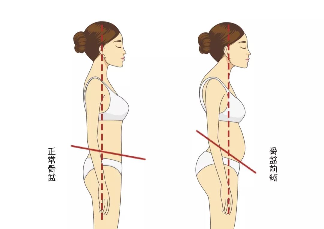 你以為的翹臀可能是骨盆前傾再這樣下去小心離好身材越來越遠