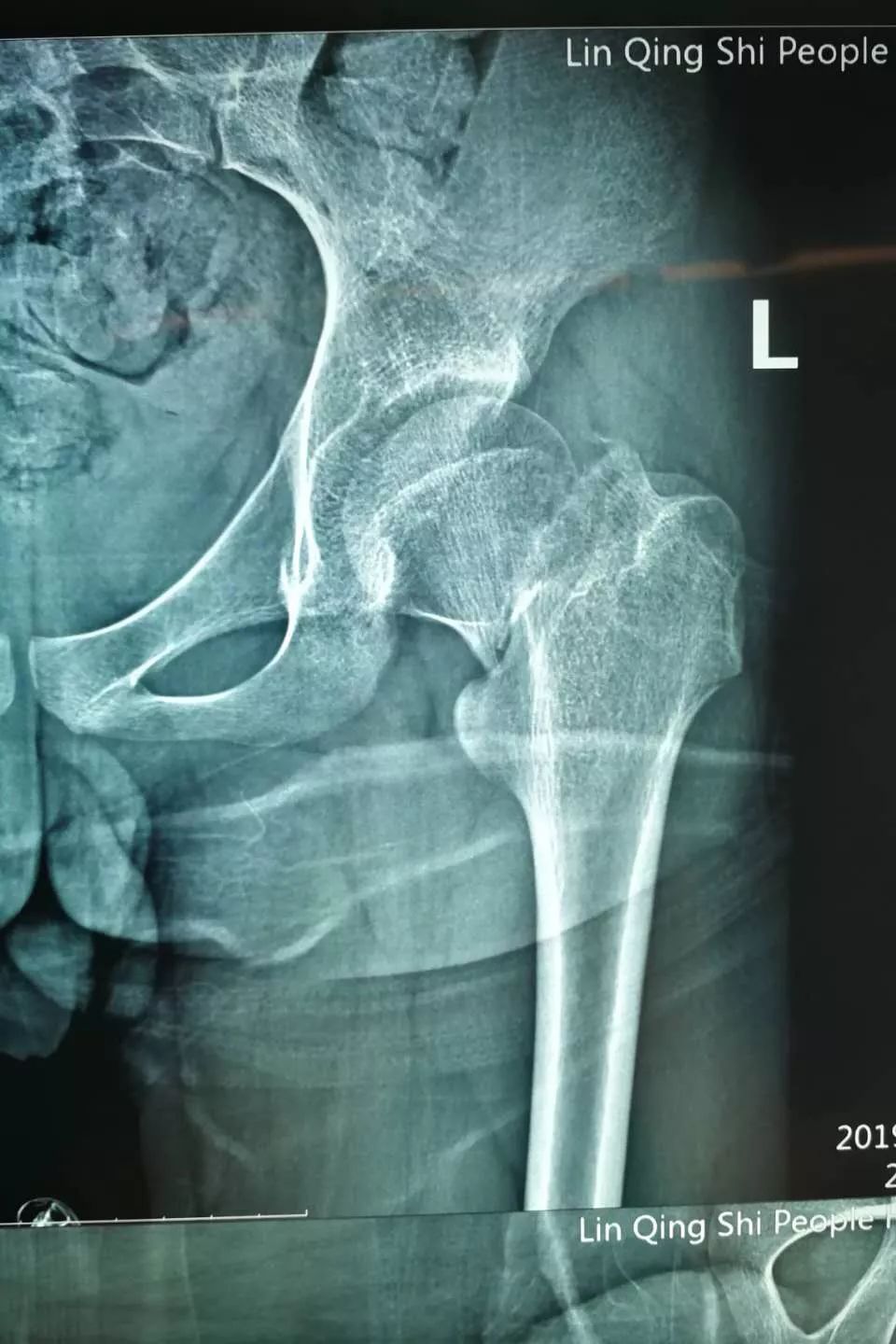 股骨颈骨折nelaton线图片