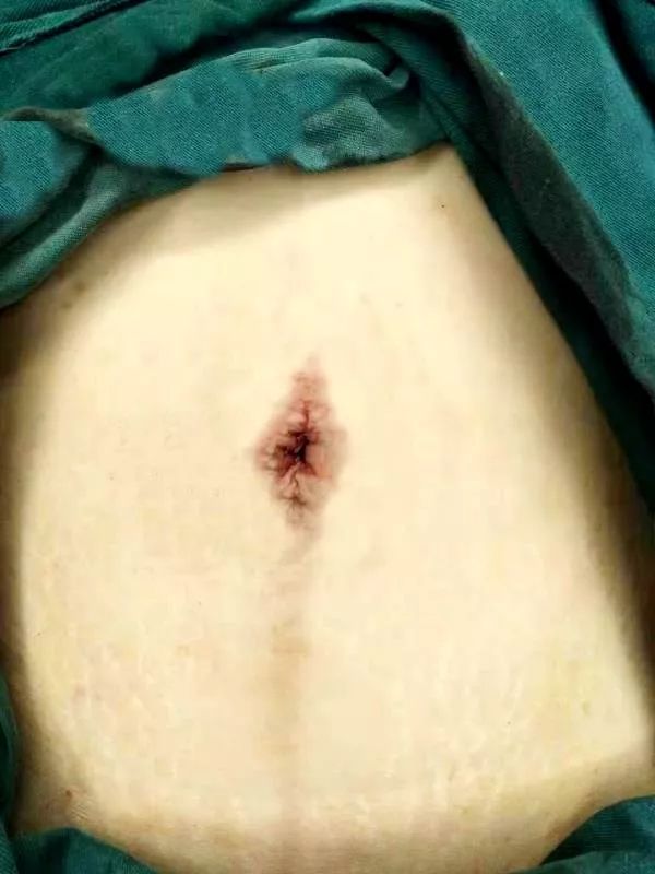 腹腔镜疤痕图图片