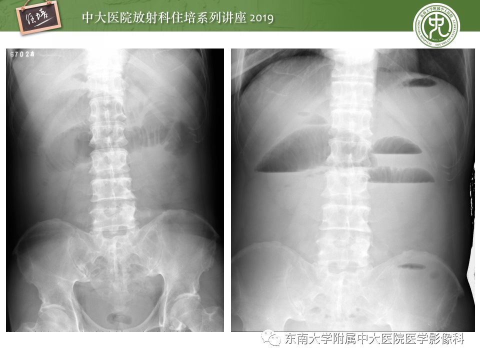 【中大放射住培系列讲座 第54期】小肠梗阻的影像分析与诊断