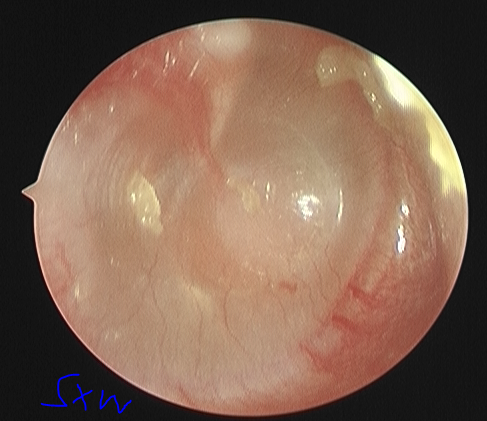 中耳炎耳镜图图片