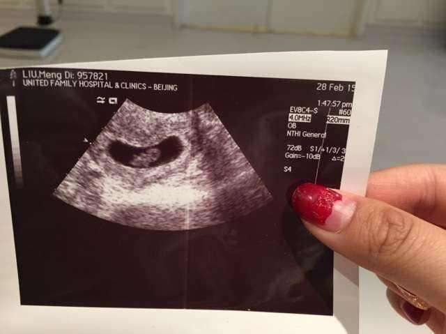 孕5周有胎心后出现褐色分泌物没在意做nt时被要求放弃妊娠