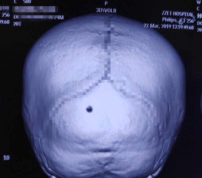 头部长骨瘤的图片图片