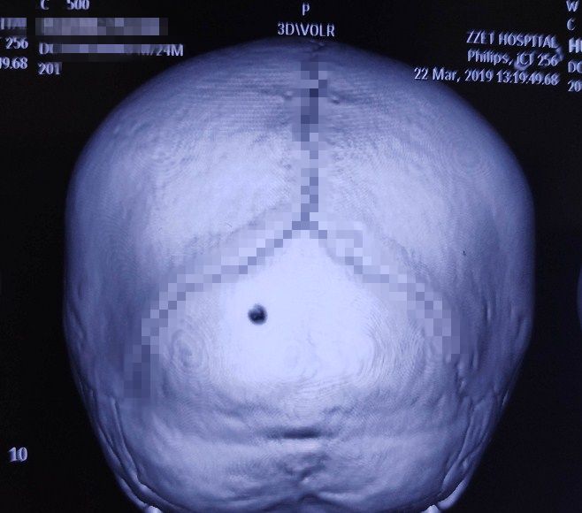 神经外科专家李涛带着孩子进行ct检查后,结果提示孩子左侧枕骨骨折