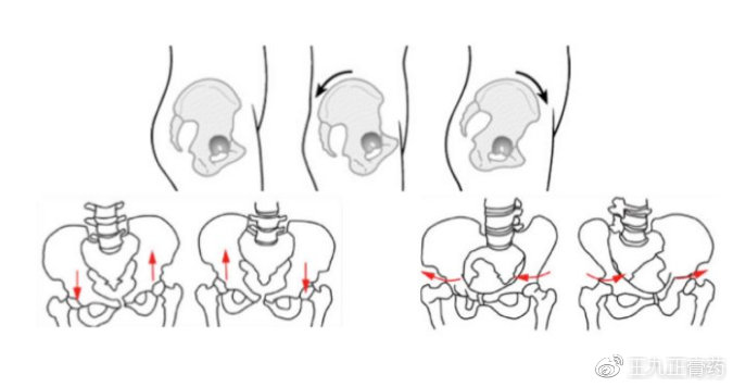 什么是骨盆旋移综合征?