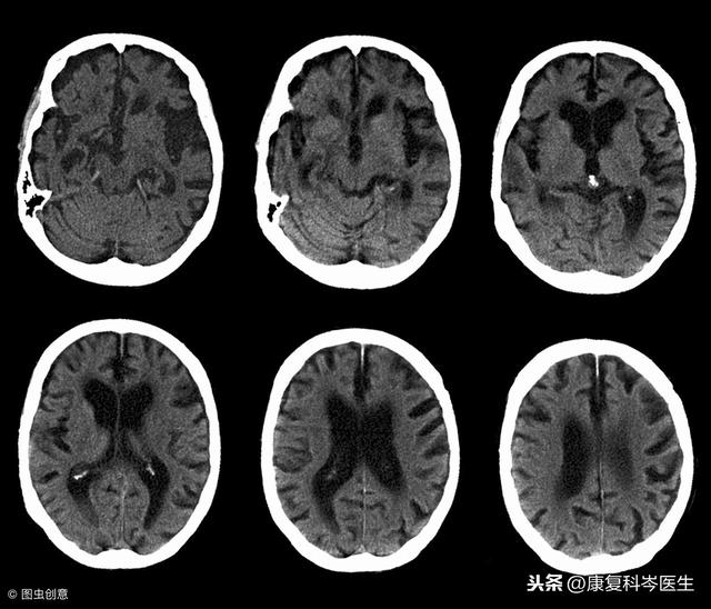 腦ct提示腦萎縮咋辦嚴重嗎要吃藥嗎今天總算知道了