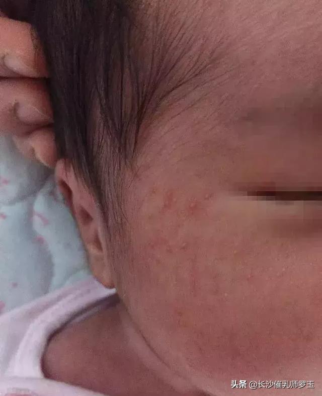婴儿皮肤干燥起红疹图片