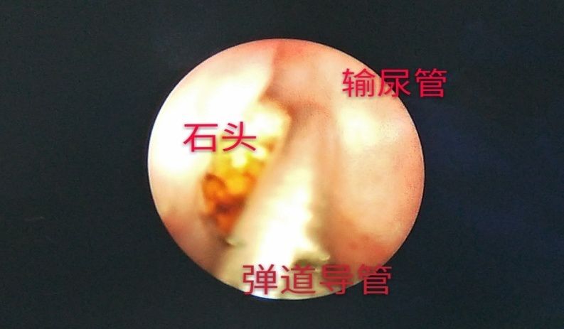 在輸尿管鏡下看到的左側輸尿管結石你沒有看錯,這個比手指頭細很多