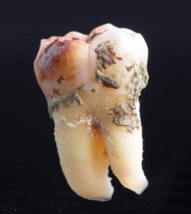 牙垢是附着在牙齿表面的牙菌斑与食物残渣互相作用后钙化,主要是外源
