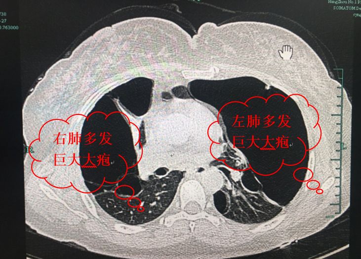 右肺尖肺大泡图片