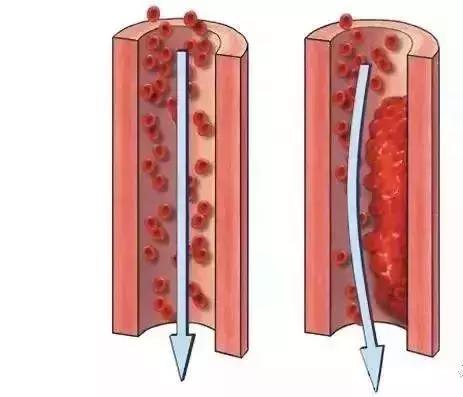 血栓弹力图高凝状态图片