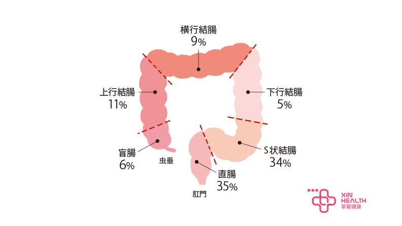 大肠癌好发部位图片