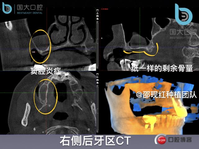 风险的背后是机会严重骨缺损伴上颌窦炎症的上颌即刻负重