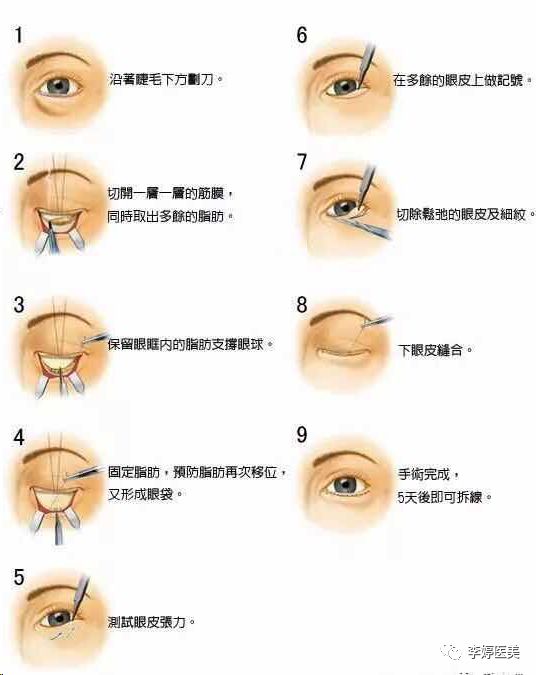 翻上眼皮技巧图解图片