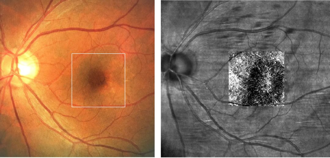 octa左眼黄斑区见脉络膜新生血管信号(圆圈)