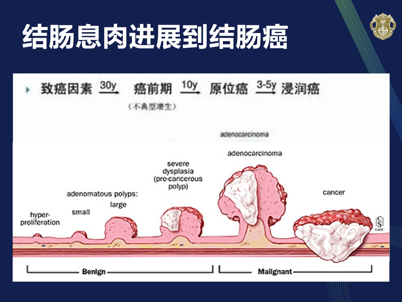 患教科普 | 宋純教授《大腸癌可以早期發現嗎?》