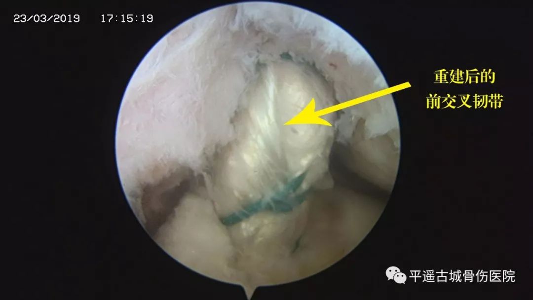 關節鏡系統已進入患者左膝關節內,可見其左膝前交叉韌帶已完全斷裂.