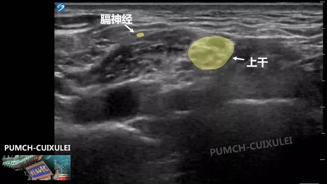 神經阻滯第二彈超聲引導臂叢神經阻滯上篇