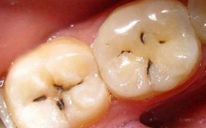 牙齿有黑线是什么原因图片