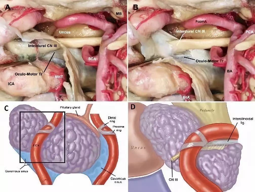 經鼻入路,可觀察頸內動脈(ica)海綿竇段水平部上方與前膝後方的海綿竇