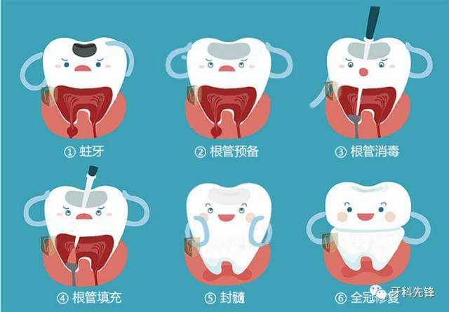 根管治療——拯救爛牙的黃金武器