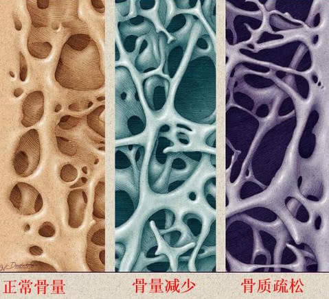 骨質疏鬆症是一種以全身骨量減少,骨組織微結構退化為特徵的全身性