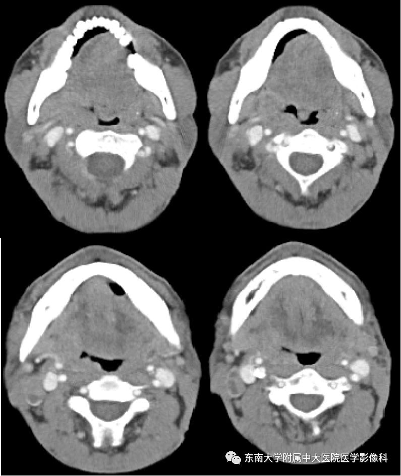 头颈部扁桃体癌影像学表现