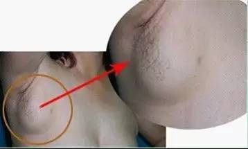 女人乳房外侧腋下有痣图片