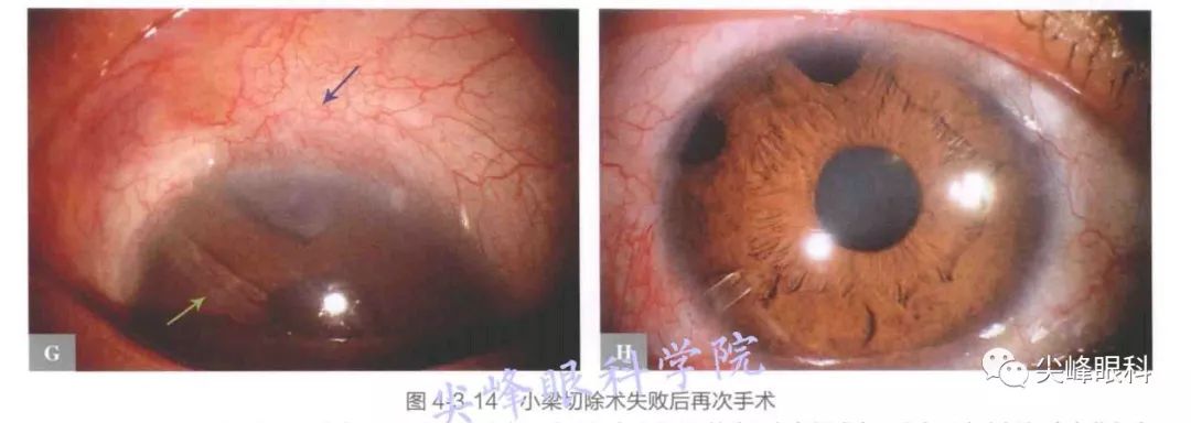 眼睛小梁切除术图片