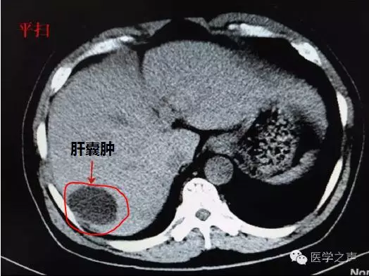 肝囊肿在什么位置图片图片
