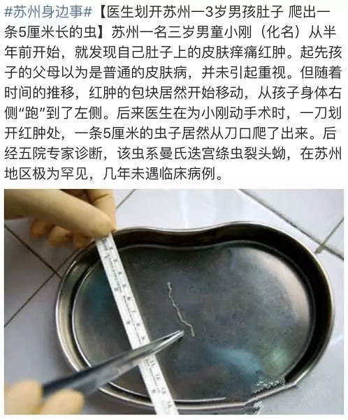 肚子有虫子的症状图片图片