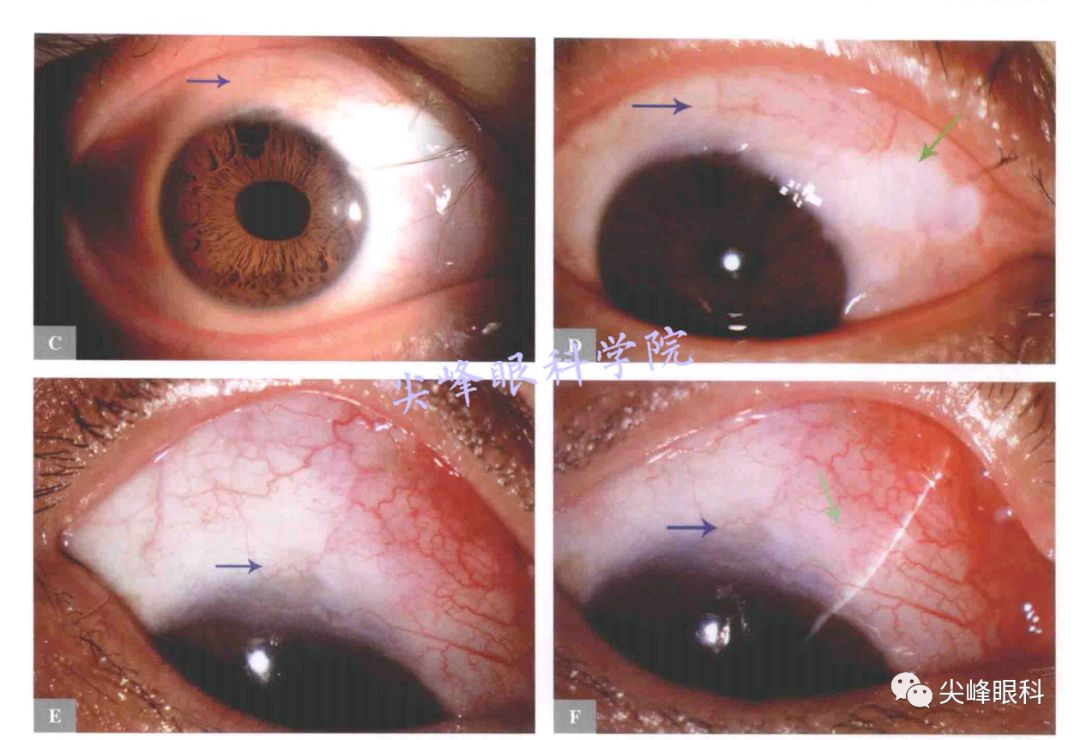 小梁切除术 后遗症图片
