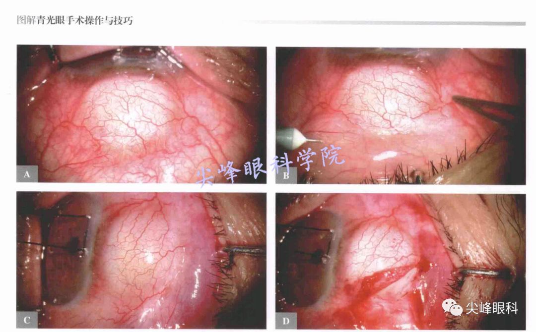 小梁切除术 后遗症图片