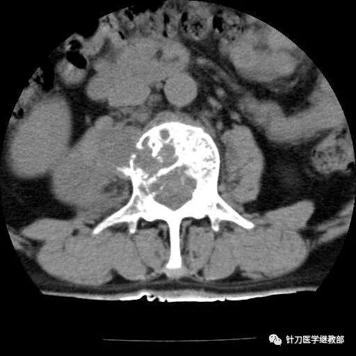 腰方肌功能解剖