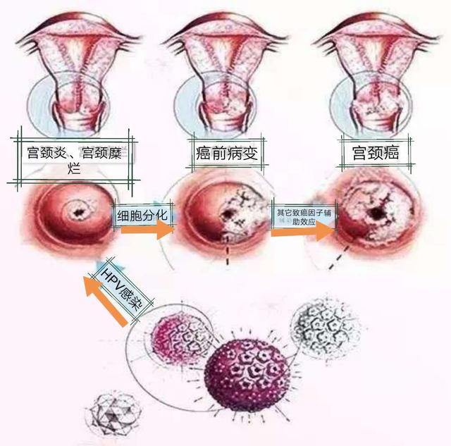 女人宫颈癌的前兆初期图片