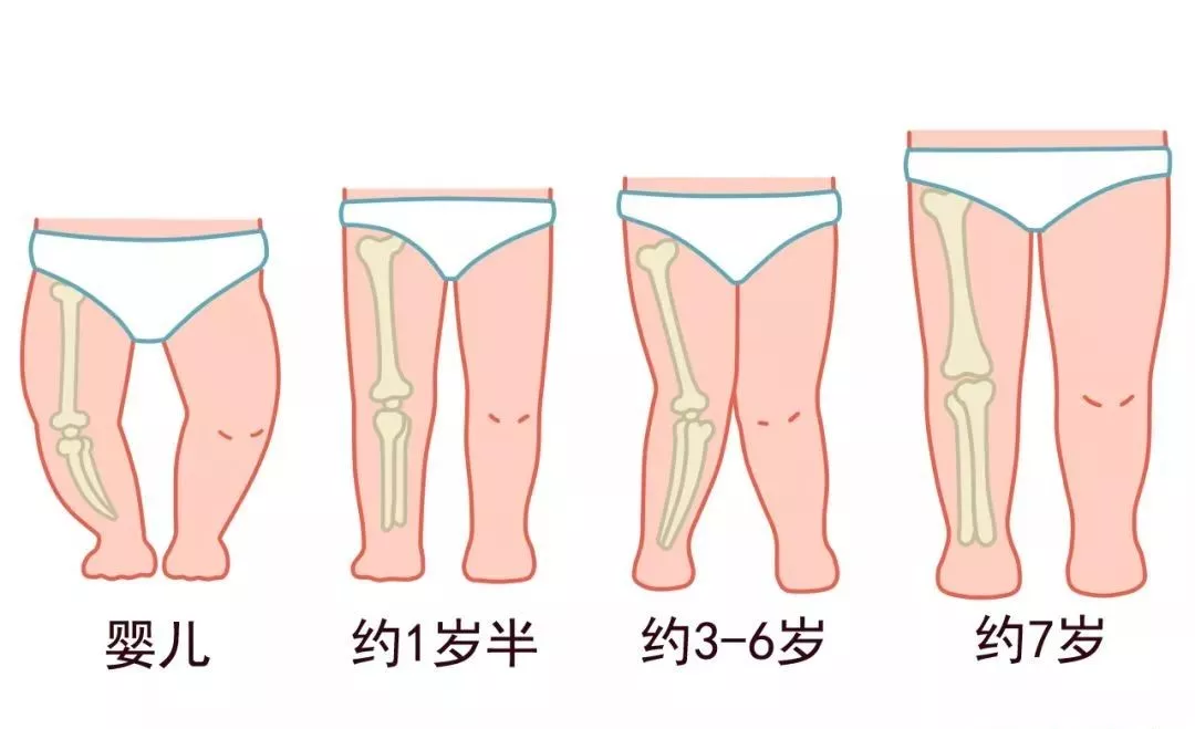 变成直腿 3~6岁 部分宝宝开始出现膝外翻,看上去像"x型腿,但也有