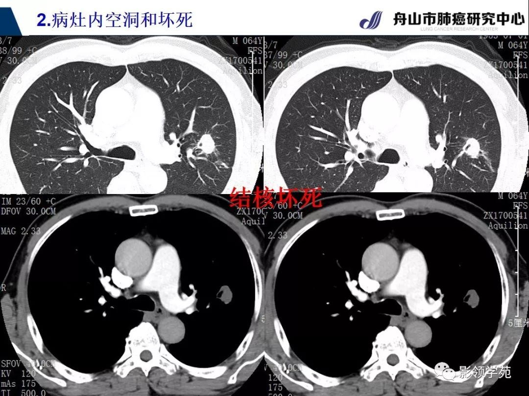 經典課堂早期周圍型肺鱗癌ct診斷及鑑別診斷上