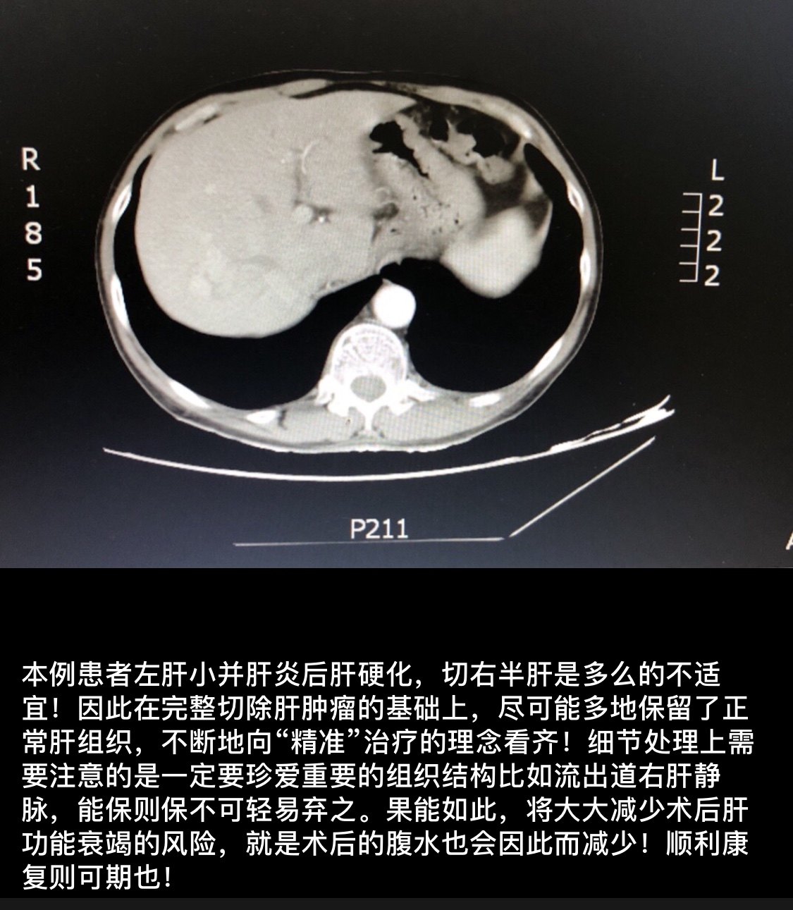 肝右后叶图片